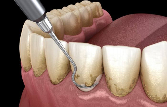 Scaling of Teeth